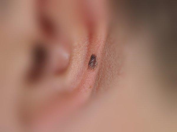 A 10-year-old CNN outperforms frontier LLMs for skin cancer diagnosis